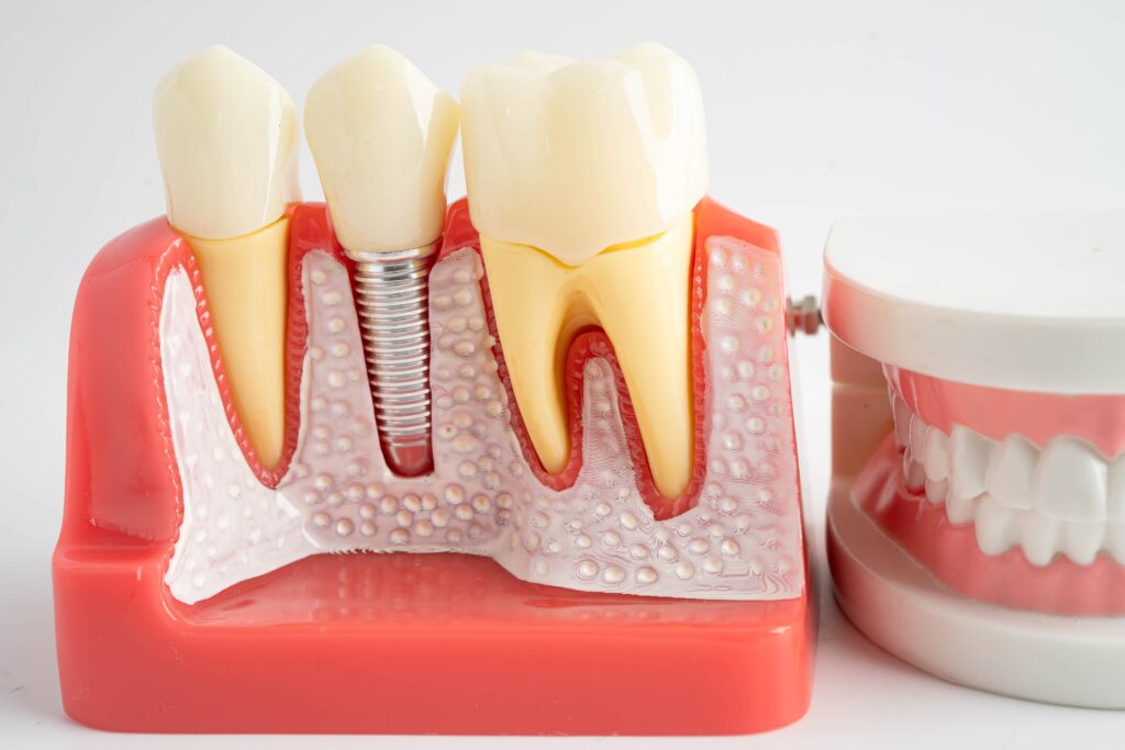 Dental Implants Vancouver
