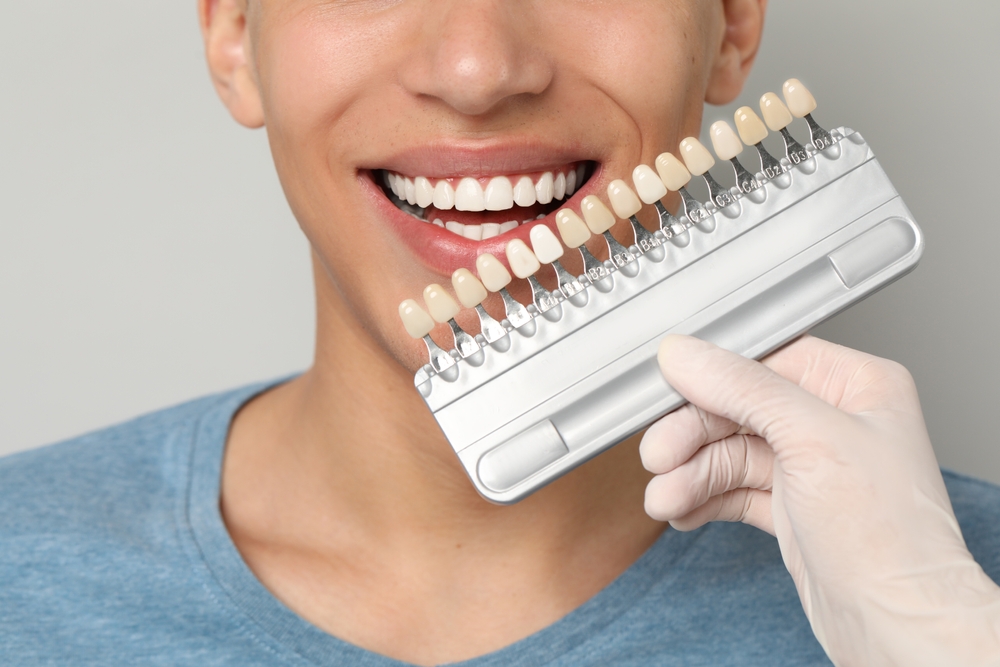 Veneers Vancouver